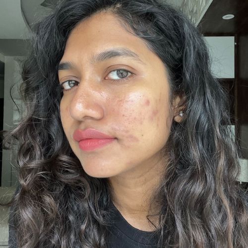 Acne or Pimples